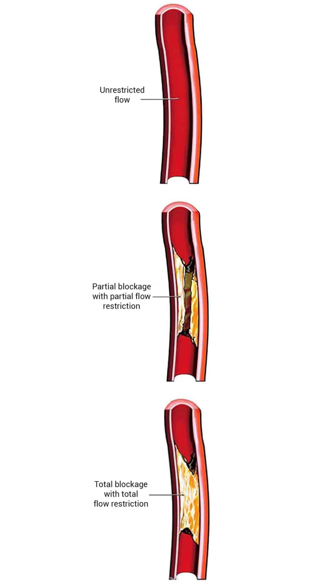 Heart Blockage & Symptoms of Blocked Arteries