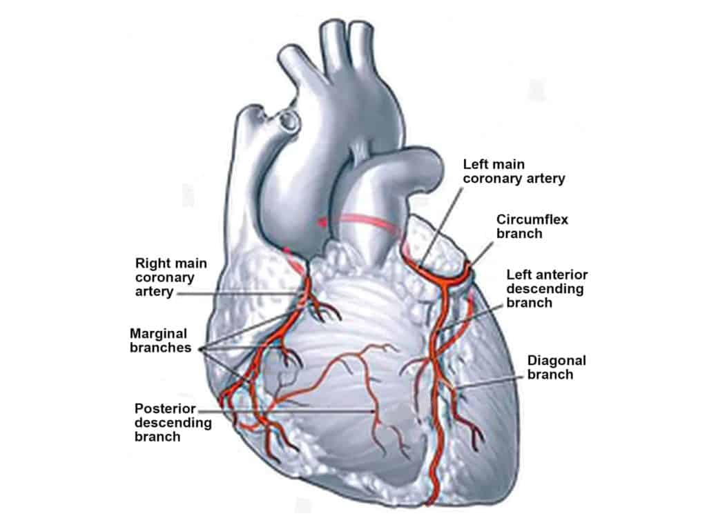 Heart Blockage or Blocked Arteries