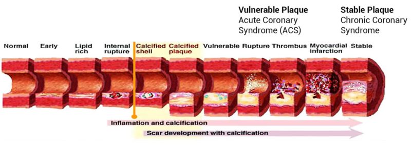 Heart Blockage & Symptoms of Blocked Arteries