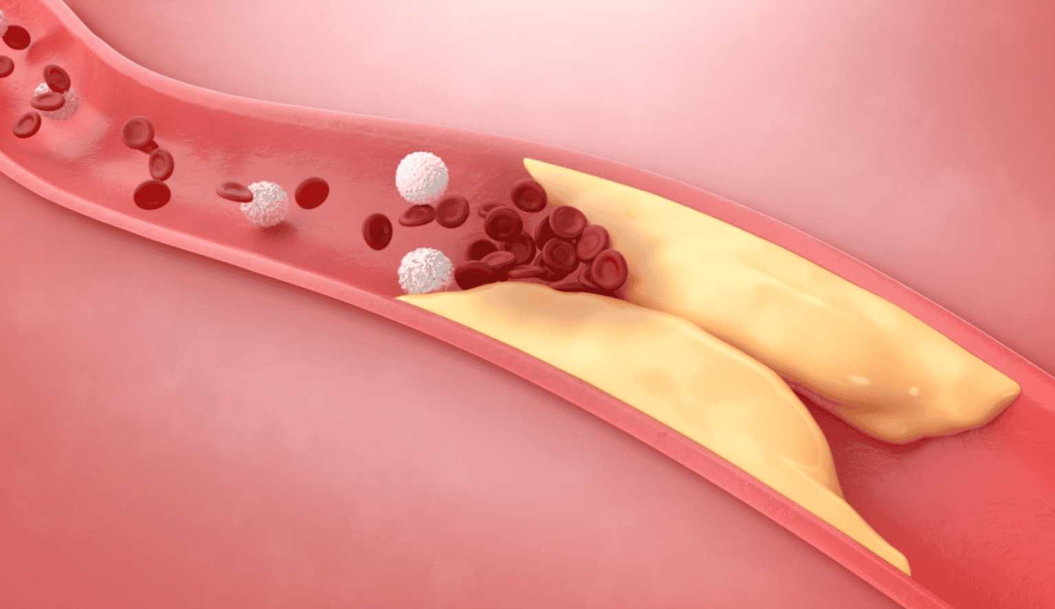 Penyumbatan pembuluh arteri | Arteriosklerosis